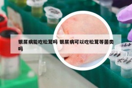 銀屑病能吃松茸嗎 銀屑病可以吃松茸等菌類(lèi)嗎