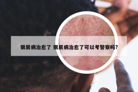 銀屑病治愈了 銀屑病治愈了可以考警察嗎?