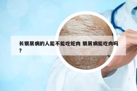 長(zhǎng)銀屑病的人能不能吃蛇肉 銀屑病能吃肉嗎?