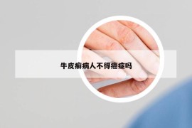 牛皮癬病人不得癌癥嗎