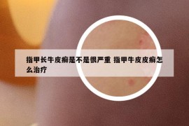指甲長(zhǎng)牛皮癬是不是很?chē)?yán)重 指甲牛皮皮癬怎么治療