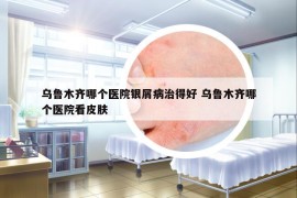 烏魯木齊哪個(gè)醫(yī)院銀屑病治得好 烏魯木齊哪個(gè)醫(yī)院看皮膚