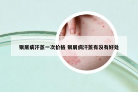 銀屑病汗蒸一次價(jià)格 銀屑病汗蒸有沒(méi)有好處