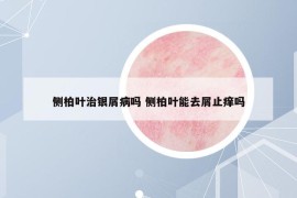 側(cè)柏葉治銀屑病嗎 側(cè)柏葉能去屑止癢嗎