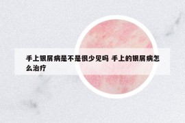 手上銀屑病是不是很少見(jiàn)嗎 手上的銀屑病怎么治療