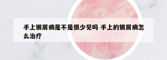 手上銀屑病是不是很少見(jiàn)嗎 手上的銀屑病怎么治療